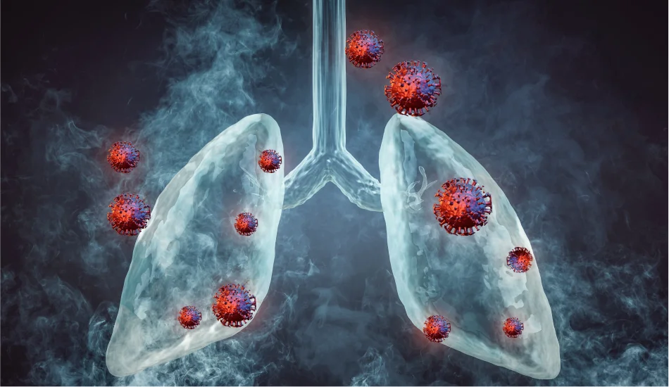 Lung Cancer Causes, Symptoms, Diagnosis and Prevention